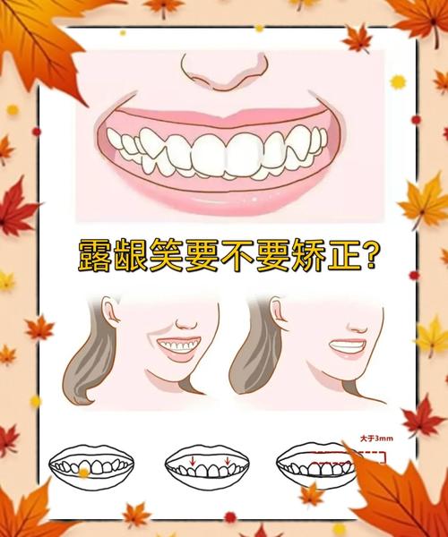 正畸露龈笑解决方案-图2