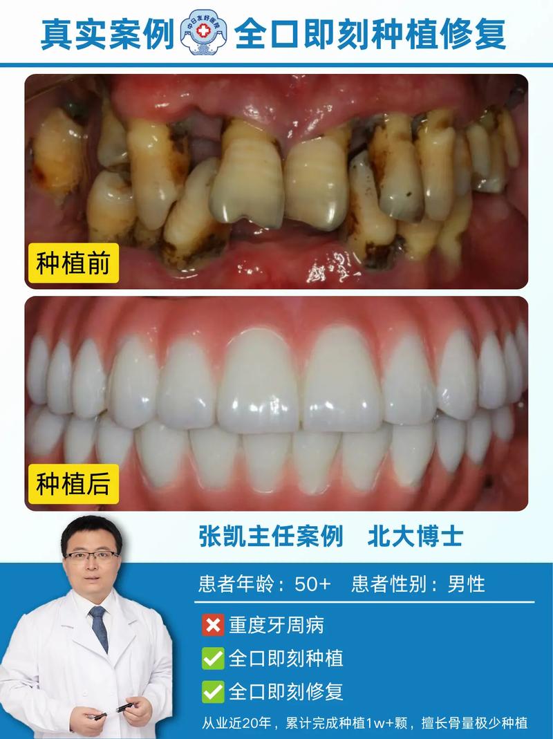 慢性牙周病种牙前必须先治疗吗?-图3 慢性牙周病种牙前必须先治疗吗?-图3