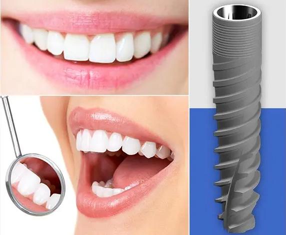 以色列种牙技术-图3