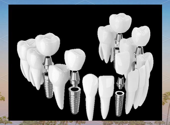 以色列种牙技术-图2