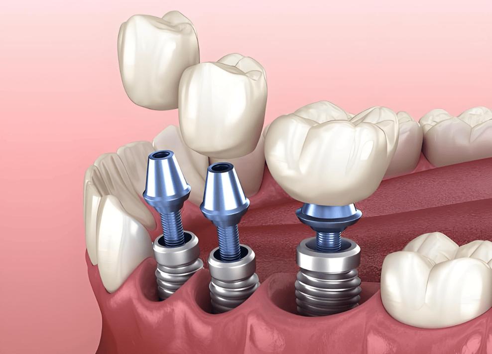 百万医疗 种牙-图2 百万医疗 种牙-图2