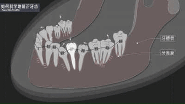 正畸牙齿移动动态图-图1