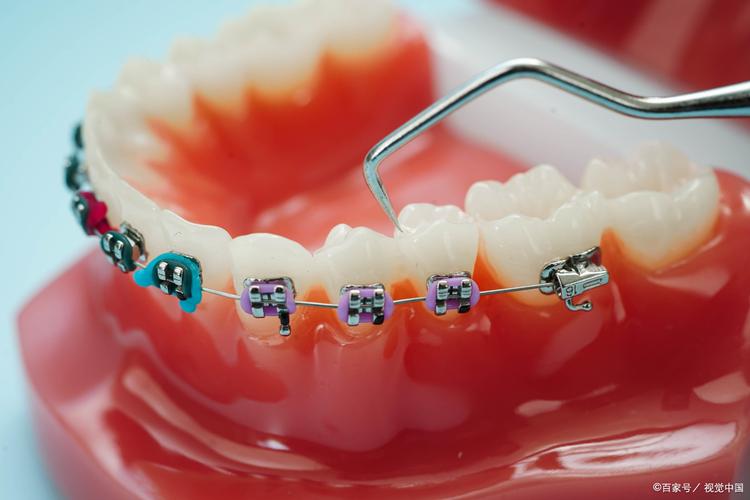 2x4固定正畸技术适合哪些牙齿矫正需求？-图2