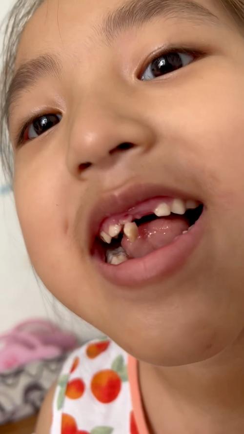 牙齿掉了 种牙-图2