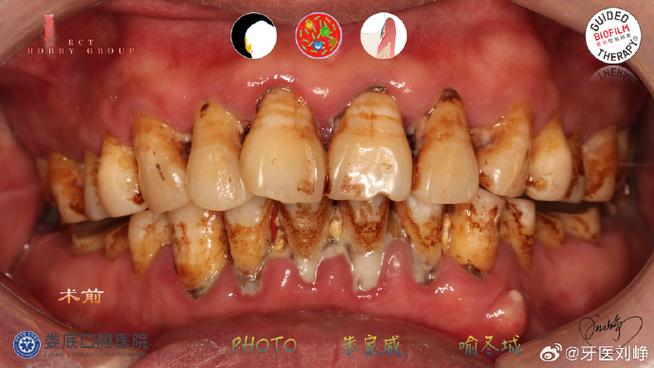 种牙 金属过敏-图1