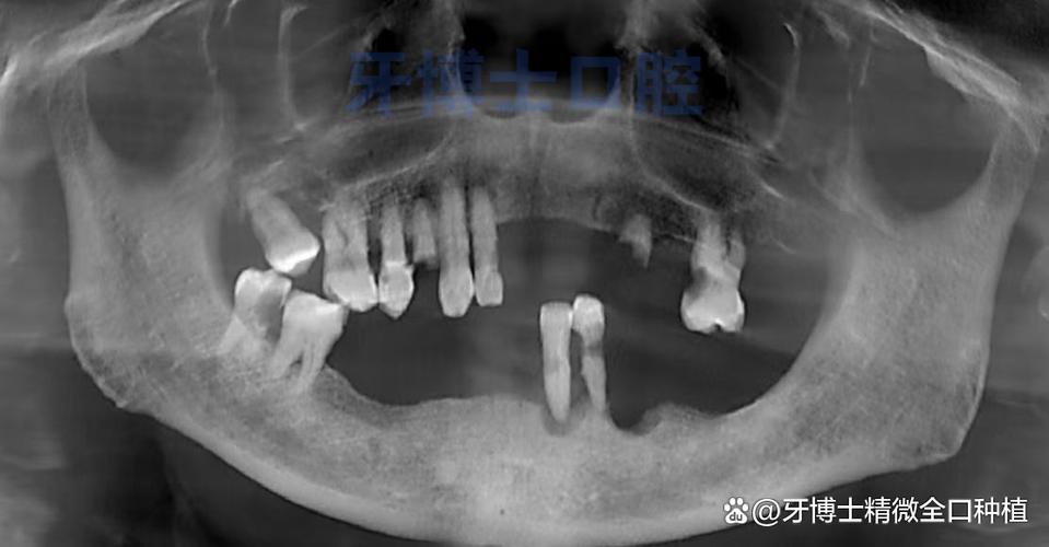 不种牙上牙松动-图2