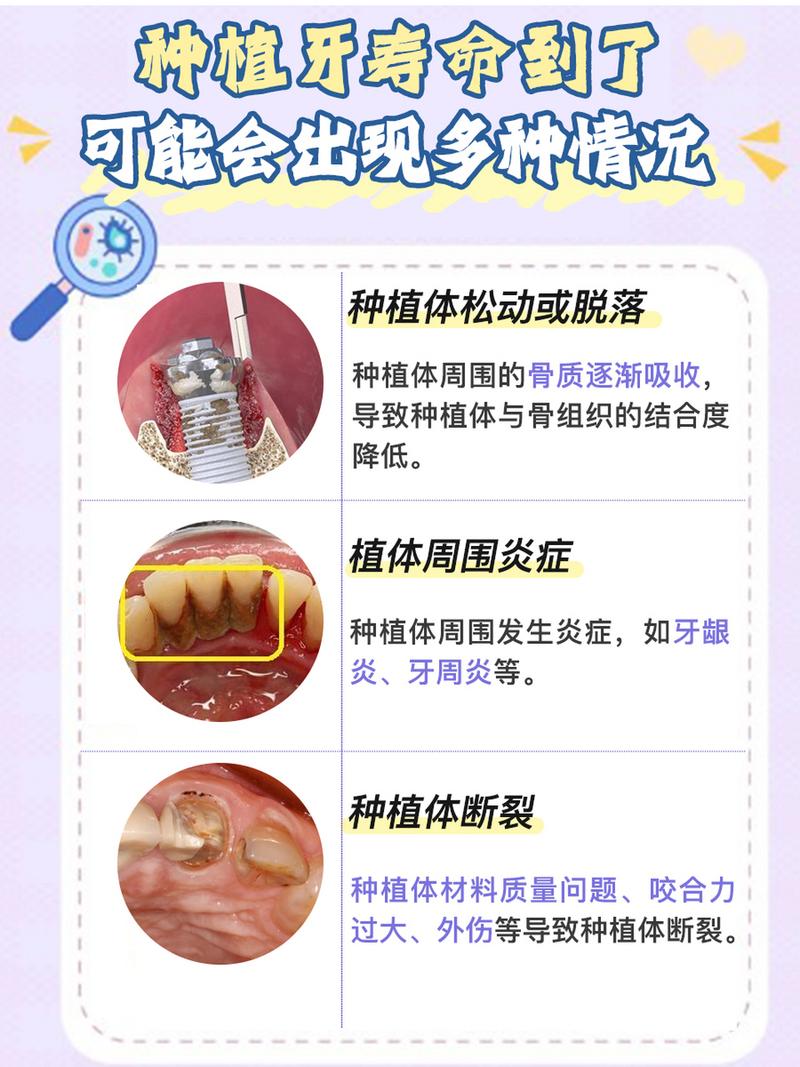 套牙种牙的寿命-图1 套牙种牙的寿命-图1