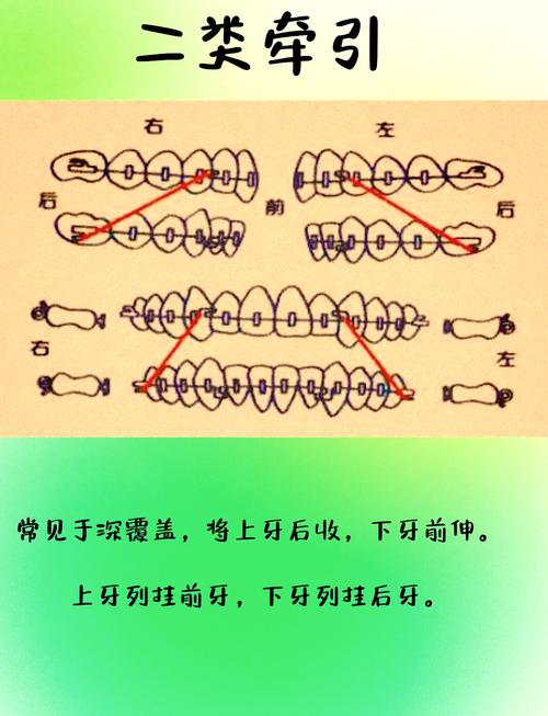 正畸J勾的使用方法-图1