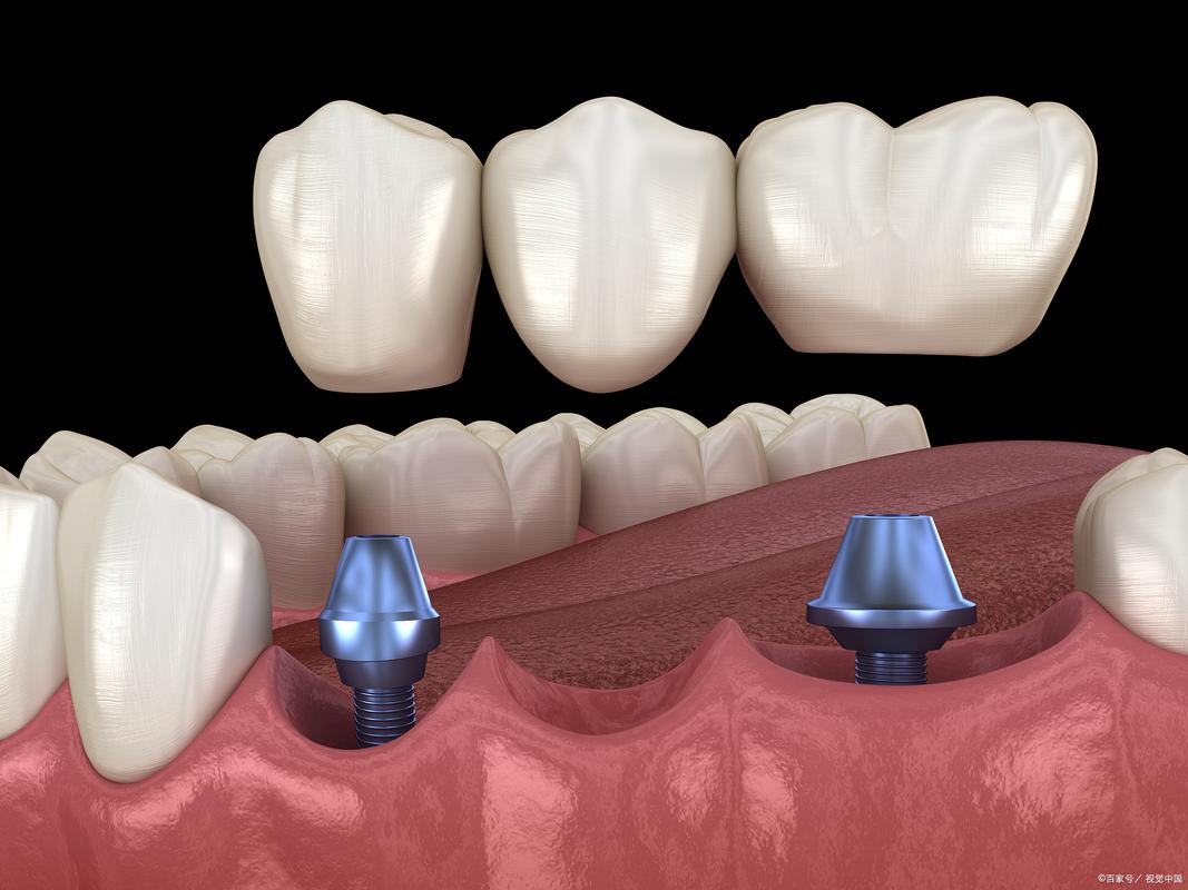 牙博士种牙水平-图2
