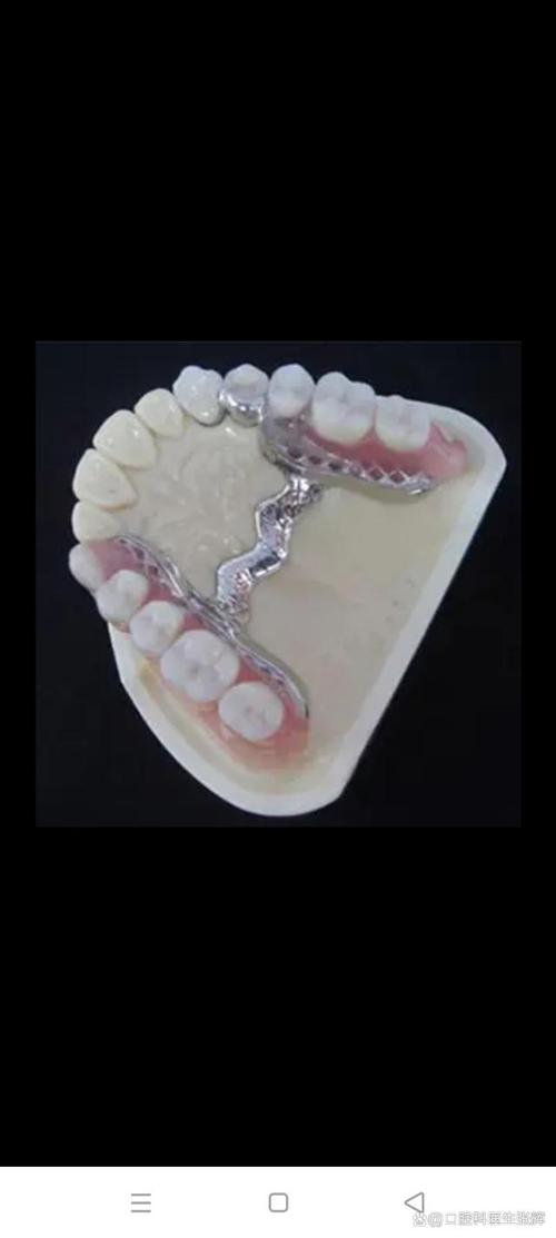 种牙镶牙活动牙-图1