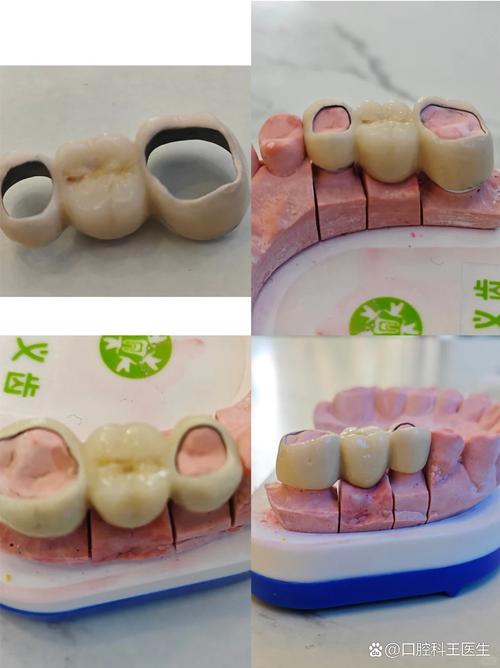 种牙镶牙活动牙-图2