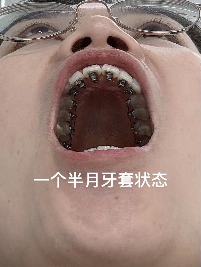 舌侧正畸费用大概需要多少钱?-图2 舌侧正畸费用大概需要多少钱?-图2