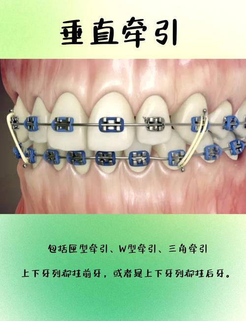 正畸摇椅弓丝的适应症具体有哪些？适合哪些错颌畸形？-图2