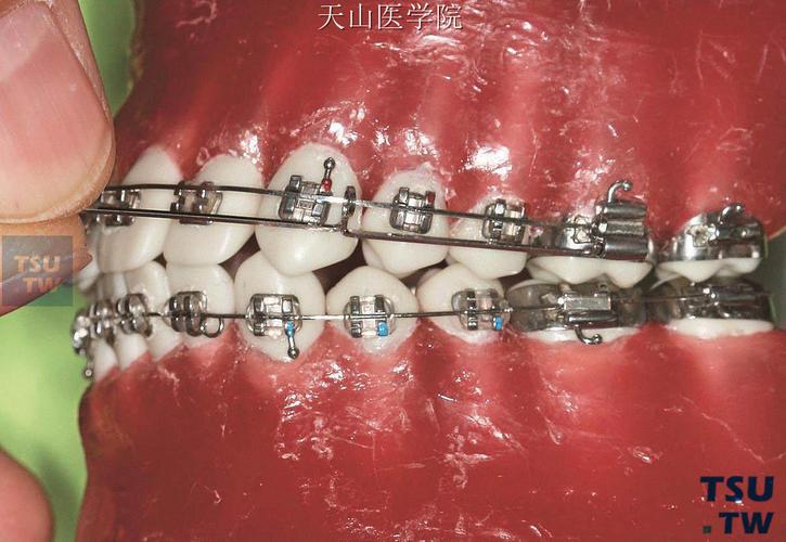 正畸弓丝弯制比赛6-图2
