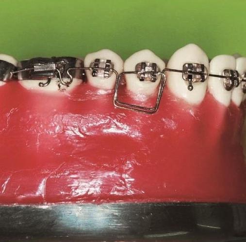 正畸弓丝弯制比赛6-图1