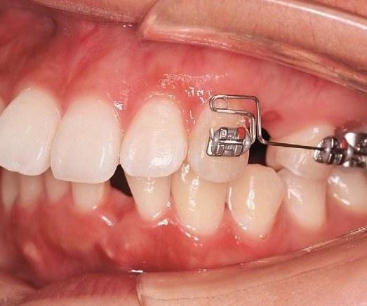 正畸弓丝弯制比赛6-图3