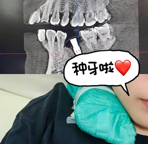 珠海种牙哪里好？求推荐技术好、口碑佳的靠谱医院-图2