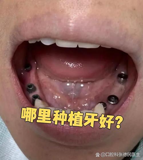 珠海种牙哪里好？求推荐技术好、口碑佳的靠谱医院-图3