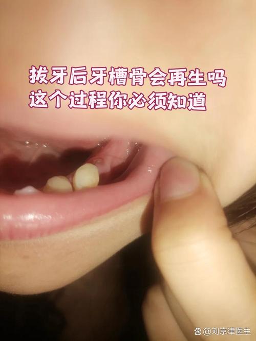 拔牙后不能种牙-图2