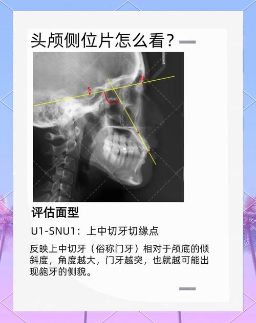 正畸头侧位影像中Z点该如何精准定位?-图1 正畸头侧位影像中Z点该如何精准定位?-图1