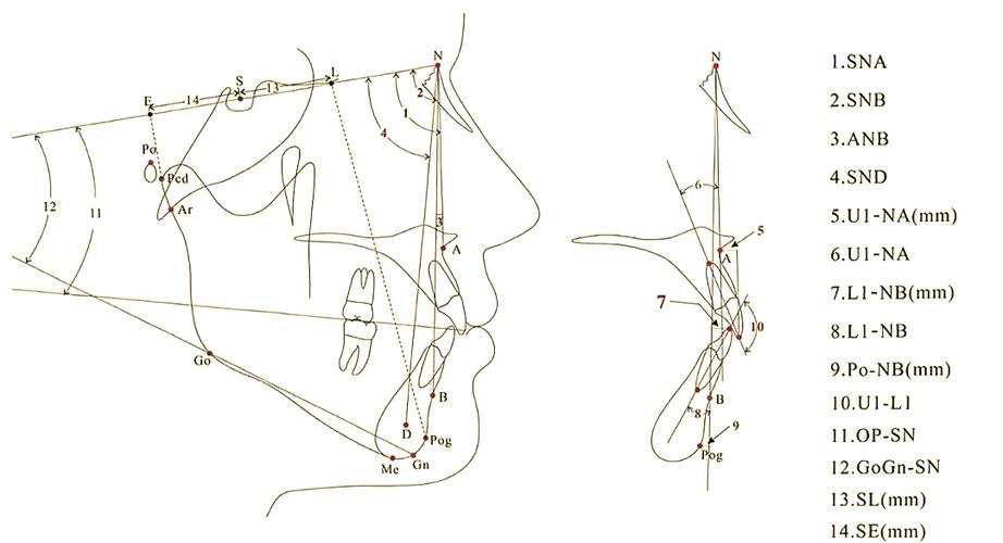 正畸头侧位影像中Z点该如何精准定位?-图3 正畸头侧位影像中Z点该如何精准定位?-图3
