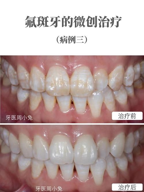 氟斑牙可以做正畸矫正吗？-图2