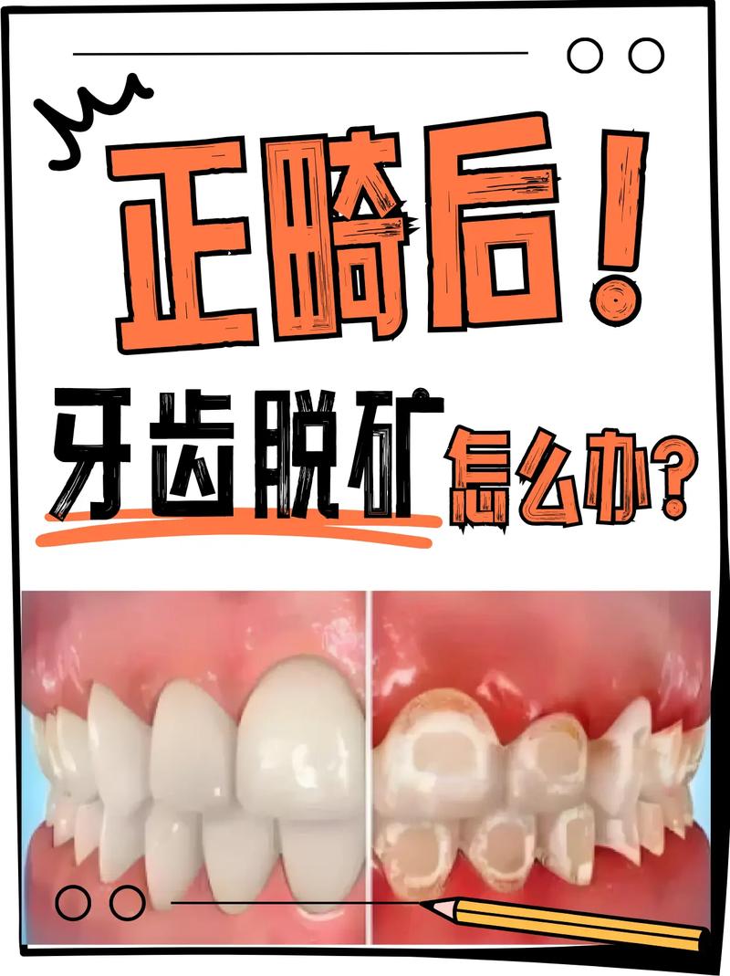 正畸后牙齿脱矿是什么原因？该如何科学预防与处理？-图2