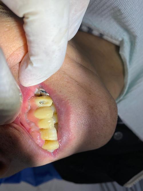 种牙失败的表现-图2