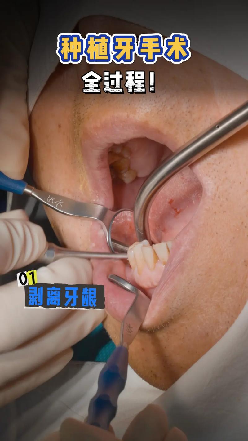 微创种牙怎么样-图3 微创种牙怎么样-图3