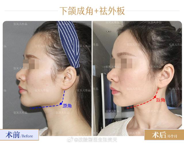 拔6正畸脸型会变吗-图2