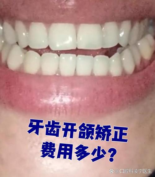 正畸牙齿要2万多吗-图2