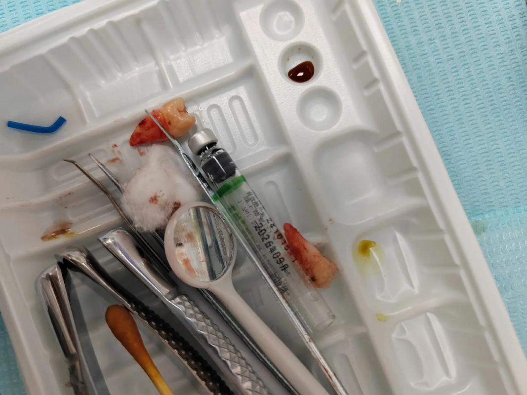 牙齿正畸 拔四颗牙-图3