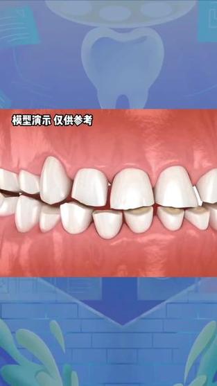 夜磨牙能种牙吗-图2 夜磨牙能种牙吗-图2