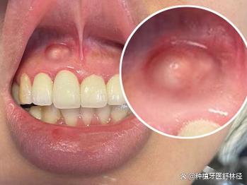 种牙后牙龈脓包-图3