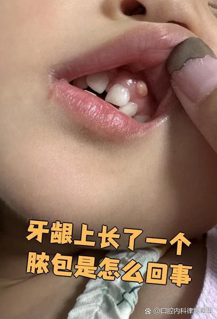 种牙后牙龈脓包-图1