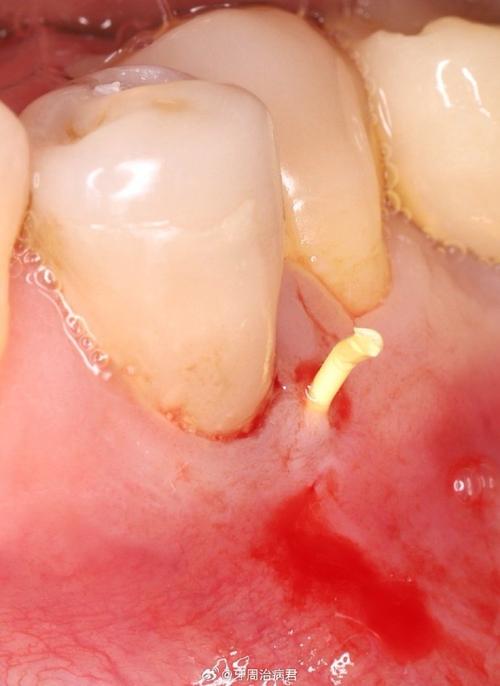 种牙后牙龈脓包-图2