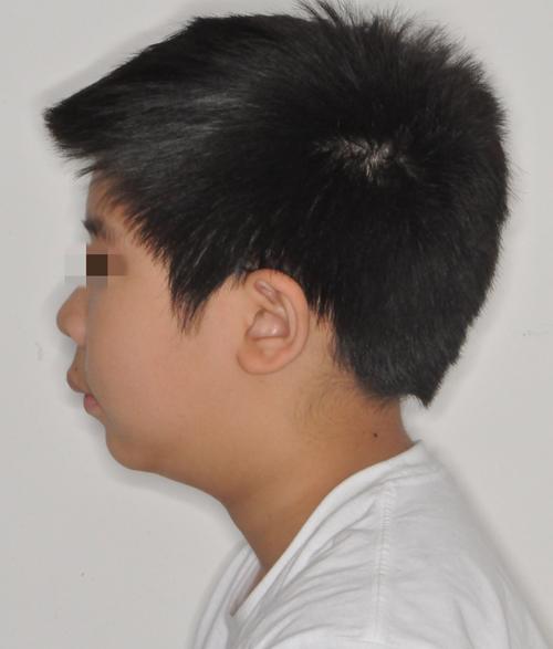 正畸后改变下颌后缩-图3