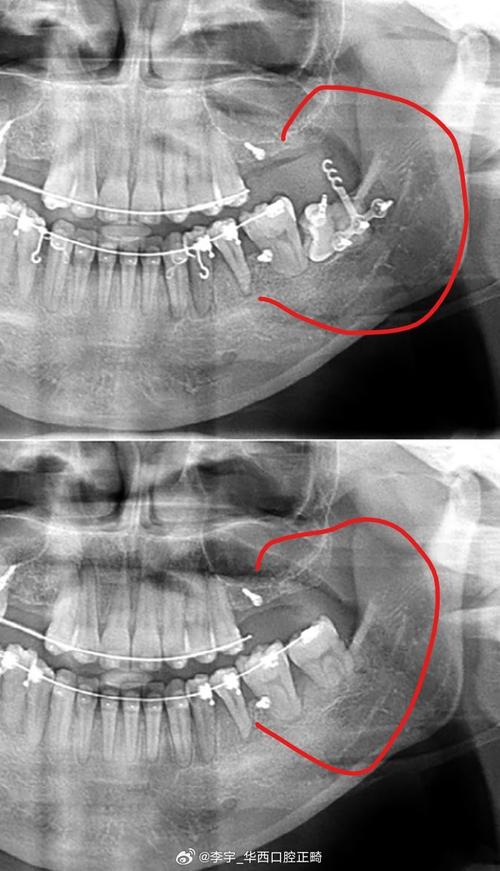 低位水平阻生齿正畸-图1
