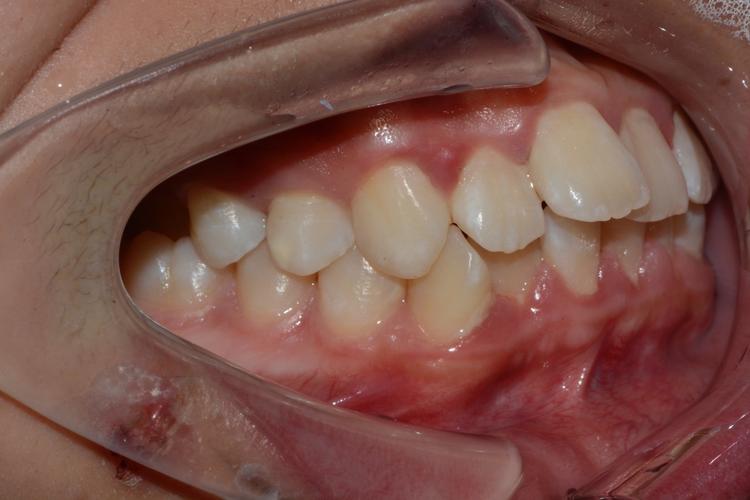 低位水平阻生齿正畸-图2