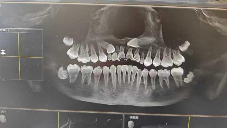 低位水平阻生齿正畸-图3