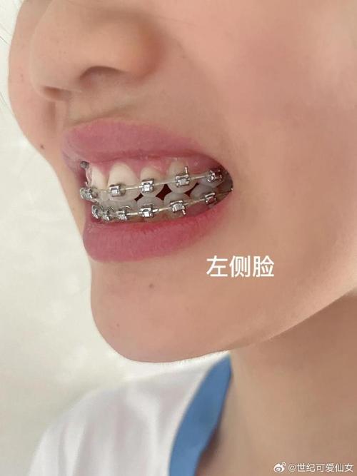 正畸总是咬舌头一侧-图2