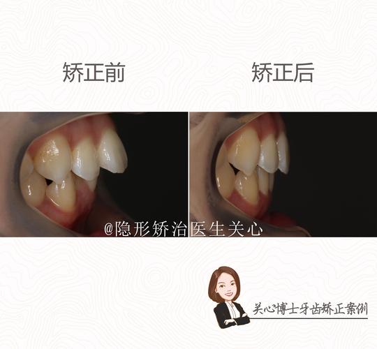 23岁上颌前突正畸-图3