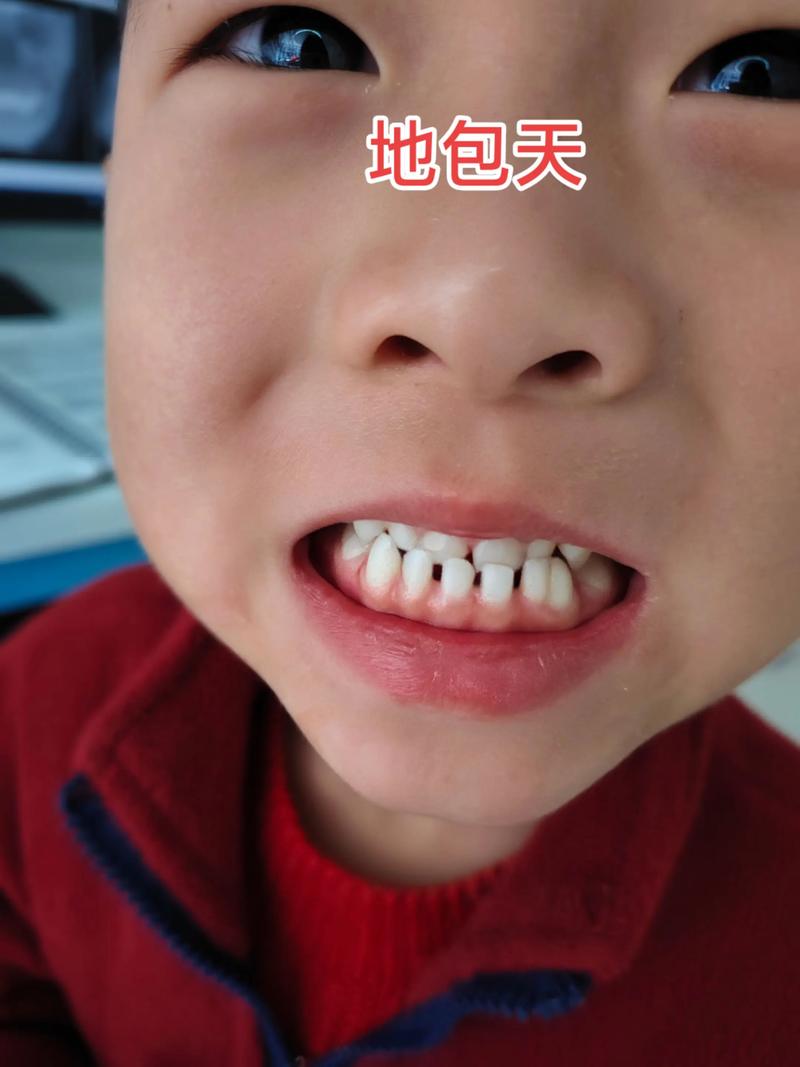 正畸三类牵引地包天-图3