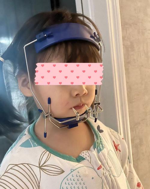 正畸三类牵引地包天-图2