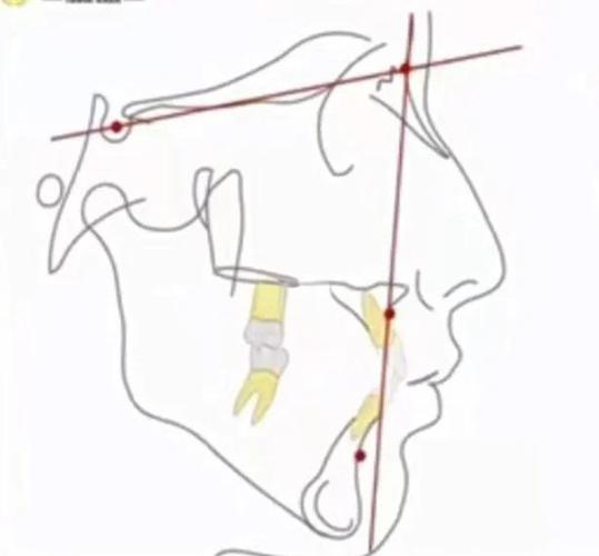 没有头影测量的情况下进行正畸，真的靠谱吗？-图3