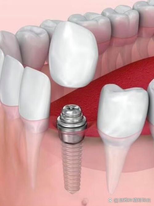 种牙麻药打哪里-图2