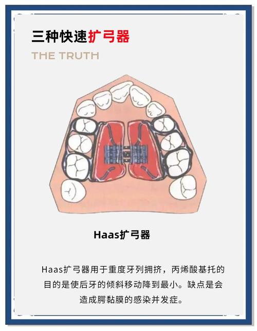 正畸螺旋扩弓器英文-图2