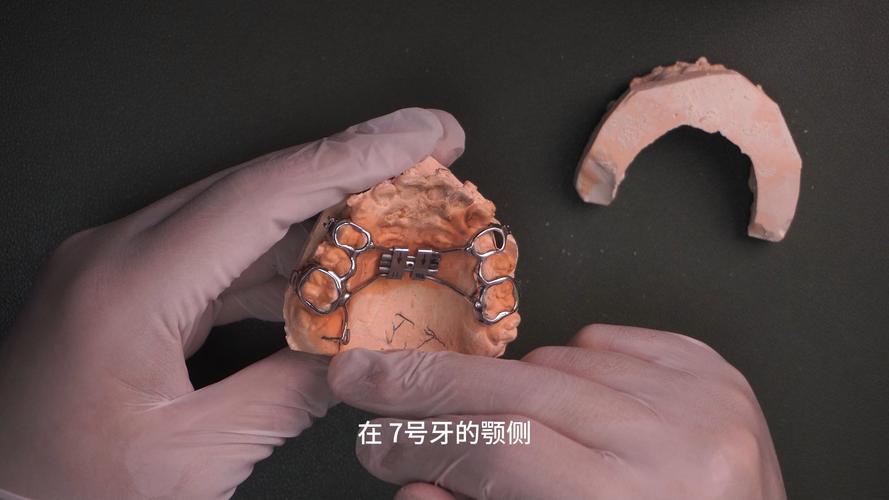 牙齿正畸口腔扩充器-图3