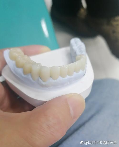 种牙哪种材质好-图1 种牙哪种材质好-图1