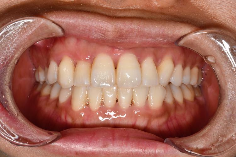 广州成年人牙齿正畸-图2